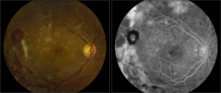 Diabetic retinopathy